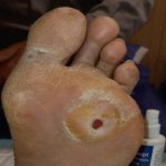 دلیل زخم شدن پا در افراد دیابتی