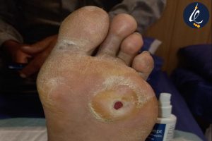 دلیل زخم شدن پا در افراد دیابتی