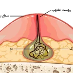 زخم کیست مویی چیست؟