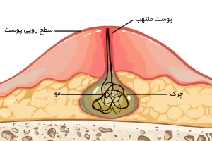 زخم کیست مویی چیست؟