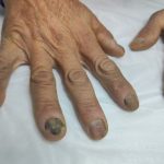 سیاه شدن ناخن در افراد دیابتی