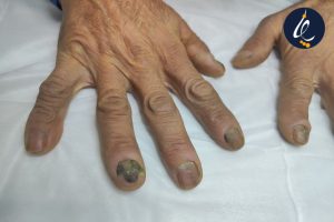 سیاه شدن ناخن در افراد دیابتی