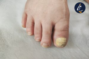 قارچ ناخن در افراد دیابتی