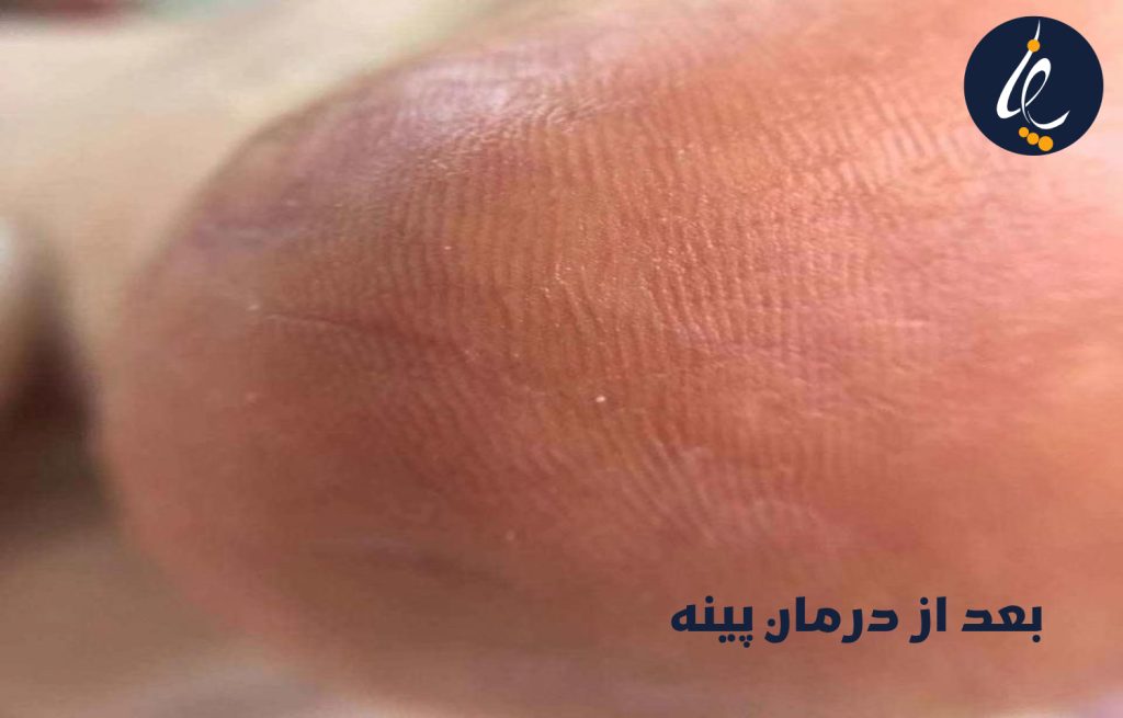 پینه یا کالوس