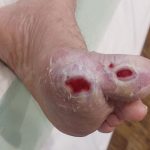 زخم دیابت چگونه درمان می‌شود؟