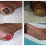 زخم پاشنه پای دیابتی