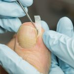 مراحل انجام ارتونیکسی ناخن