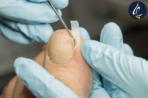 مراحل انجام ارتونیکسی ناخن
