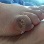 زخم انگشت دیابتی