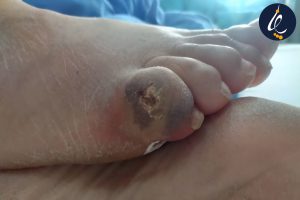 زخم انگشت دیابتی