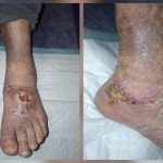 زخم وریدی یا زخم واریسی چیست؟