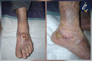 زخم وریدی یا زخم واریسی چیست؟