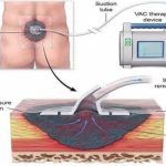 وکیوم تراپی چیست؟