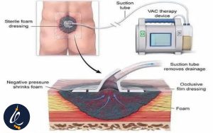 وکیوم تراپی چیست؟
