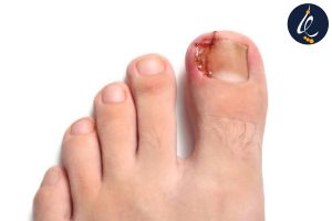 درمان زخم ناخن در کرج