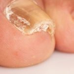 مشکلات شایع ناخن پا