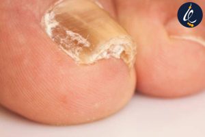 درمان مشکلات شایع ناخن پا