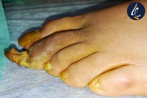 درمان ناخن در کرج