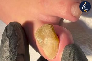 درمان ناخن شاخ قوچی