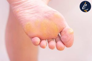 درمان پینه و میخچه در کرج