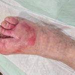 زخم مزمن و درمان آن