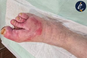 زخم مزمن و درمان آن