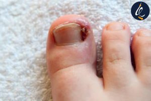 مراقبت تخصصی از زخم ناخن پا