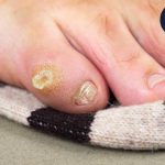 میخچه چیست و چگونه درمان می شود؟