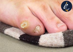 میخچه چیست و چگونه درمان می شود؟