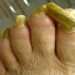 ناخن شاخ قوچی چگونه درمان میشود؟