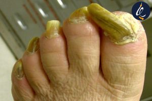 ناخن شاخ قوچی چگونه درمان میشود؟