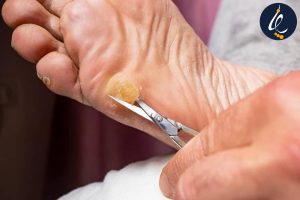 پینه چگونه درمان می‌شود؟