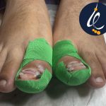 مراقبت های بعد از ارتونکسی ناخن