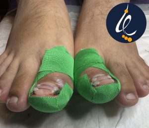 مراقبت های بعد از ارتونکسی ناخن