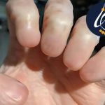 مراقبت از انگشتی که ناخن آن کنده شده