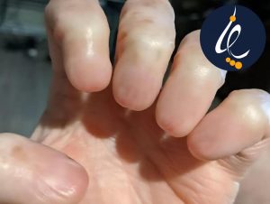 مراقبت از انگشتی که ناخن آن کنده شده