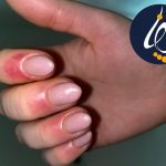 علت و درمان حساسیت ناخن