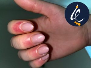 علت و درمان حساسیت ناخن