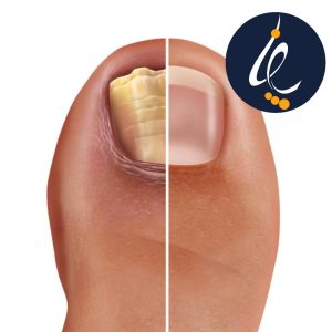 علت و درمان ناخن زرد شده