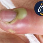 درمان ناخن چرک کرده
