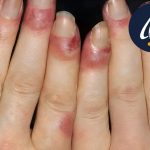 مراقبت از ناخن در شیمی درمانی