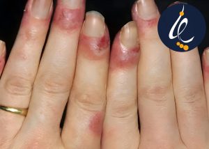 مراقبت از ناخن در شیمی‌ درمانی