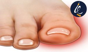 آسیب های ناخن شست پا