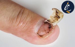 افتادن ناخن پا