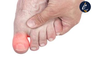 انواع مشکلات ناخن شست پا