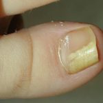 درمان خالی شدن زیر ناخن