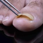 درمان ناخن در حال افتادن