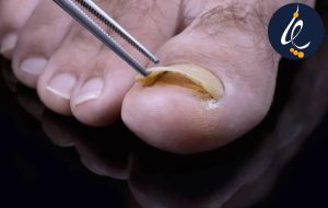 درمان ناخن در حال افتادن