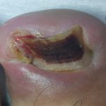 درمان ناخن زیر گوشت رفته