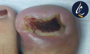 درمان ناخن زیر گوشت رفته